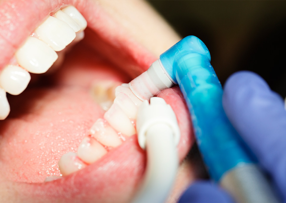 予防歯科_定期検診の重要性